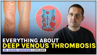 Deep Venous Thrombosis  DVT  IVC filter  Dr Gaurav Gangwani [upl. by Yasmine]