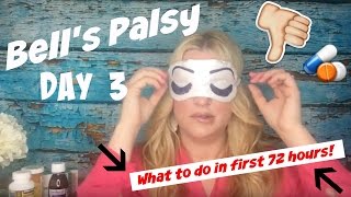 Bells Palsy Day 3 [upl. by Oilerua960]