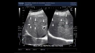 Multiple Hepatic metastasis [upl. by Atnohs]