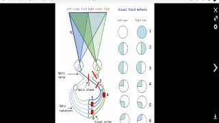 neuroophthalmology 6 a chiasmal disorder [upl. by Eidna]