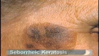 Common Skin Lesions [upl. by Maddock]