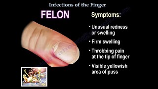 Infections Of The Finger  Everything You Need To Know  Dr Nabil Ebraheim [upl. by Sualk817]