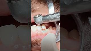 Tooth caries  composite restoration dentist [upl. by Felicdad]