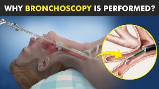 Bronchoscopy  Procedure To View Inside Of Air Ways [upl. by Mieka]