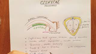 Hypospadias clinical features [upl. by Heshum]