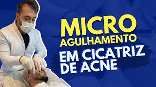 MICROAGULHAMENTO PARA CICATRIZ DE ACNE [upl. by Auqenes18]