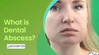 What is a Dental Abscess What are The Symptoms and How is it Treated [upl. by Ecidnacal]