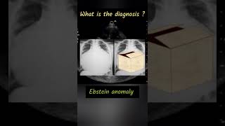 Ebstein anomaly radiology neetpg neet2024 [upl. by Ayidah]