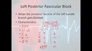 12 Lead Interpretation Part 42 Bundle Branch and Fascicular Blocks [upl. by Tice]