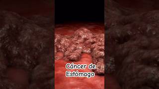 ¡Alerta Signos y síntomas de cáncer de estómago  Dr William Guerrero medicina shorts [upl. by Anomis]