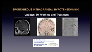 693 Síndrome de Hipotensión Intracraneal Espontánea el gran desconocido [upl. by Sturdivant]