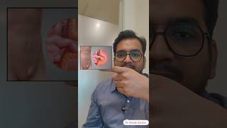 Inguinal Hernia Swelling I Laparoscopic Hernia treatment in Delhi Noida [upl. by Ivens]