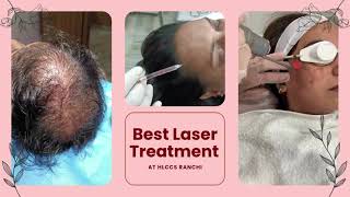 Best Laser treatment at HLCCS RANCHICall now 9334334935 laser skincare beauty laserhairremoval [upl. by Idet]