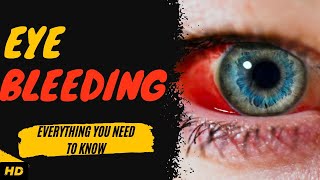 Eye Bleeding Everything You Need To Know [upl. by Jaf878]