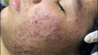 Acne treatment for Spa Linh Mun 2024 60 [upl. by Ahterod737]