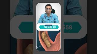 Gastroesophageal Reflux Disease In Tamil GERD shortsfeed trending viralvideo [upl. by Walter323]