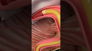 Mechanical Thrombectomy in stroke medicine anatomy science health stroke [upl. by Schwarz]