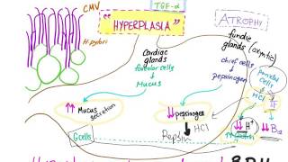 Ménètriers disease Pathophysiology [upl. by Acissey]