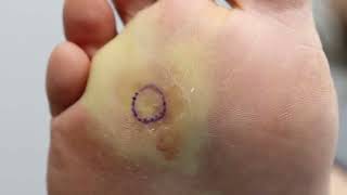 HUGE PAINFUL CORNWART REMOVAL WHAT IS IT [upl. by Denney840]