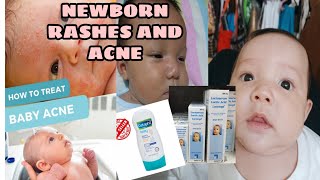 PAANO GUMALING ANG MGA BUTLIG NI BABY 😍 TIPS HOW TO GET RID NEWBORN FACE RASHES OR ACNE [upl. by Erreit482]