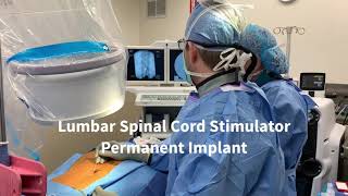 How to Perform a Lumbar Spinal Cord Stimulator Permanent Implant [upl. by Surbeck]