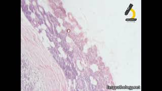 Pleomorphic adenoma [upl. by Greg]