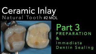 Lithium Disilicate Ceramics Part 3 Preparation and Immediate Dentin Sealing IDS [upl. by Lody]