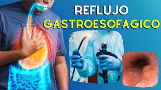 🔥 ERGE Causas Diagnostico y Tratamiento de la Enfermedad por Reflujo Gastroesofágico  Podcast [upl. by Anoblav]