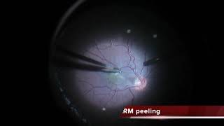 RPERetina Hamartoma Vitrectomy [upl. by Seiter579]