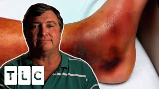 Flesh Eating Bacteria Could Cause Man To Lose His Leg  Monsters Inside Me [upl. by Calder322]