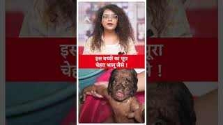 Werewolf SyndromeMalaysia की बच्ची Hypertrichosis नाम की बीमारी से पीड़ित हैजानिए डिटेल्स ABP LIVE [upl. by Gentes]