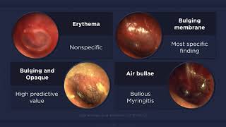 Acute Otitis Media Otoscopic Findings [upl. by Tewfik157]