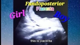 Fundoposterior placenta means baby boygirl  Cord around the baby neck  23 week scan  genderscan [upl. by Malynda830]