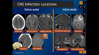 CNS Infections RadiologicPathologic Correlation [upl. by Esirrehc953]