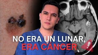 Creyó que era un lunar y resultó ser un cáncer en la piel que le causó metástasis en el cerebro [upl. by Felipe496]