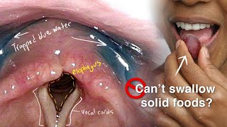 Cricopharyngeal Dysfunction Difficulty Swallowing Especially Solid Foods [upl. by Eemla]