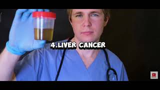 Understanding Liver Disease Symptoms Causes and Prevention  Essential Health Guide [upl. by Lonna]