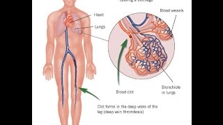 pulmonary embolism treatment [upl. by Clellan]