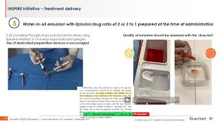 Conventional Transarterial Chemoembolization amp Drug Eluting Beds in Treating Hepatocellular CA [upl. by Bobby]