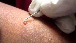 Removing H P Body From Molluscum Contagiosum [upl. by Adall]