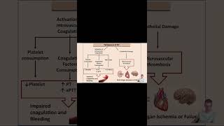 Disseminated Intravascular Coagulation DIC meded obgyn emergencymedicine criticalcare [upl. by Sprung515]