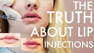 Getting Lip Injections from a Doctor  Filler 101 and Common Myths [upl. by Marian19]