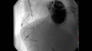 Spontaneous Thrombolysis of an Obstructed Mechanical Aortic Valve [upl. by Yerdna]