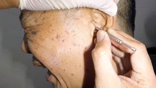 Elderly Mans Massive Earwax Removal [upl. by Deeraf]