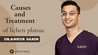 How to treat lichen planus  Lichen Planus Treatment  Lichen Planus skin disease  Hindi [upl. by Torras]