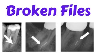 Endodontic Instrument fracture  Separated File Management of Broken Files Bypass Technique [upl. by Nikos365]