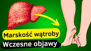 12 Pierwszych Objawów Uszkodzenia Wątroby  Przewodnik po Zdrowiu Wątroby [upl. by Broderic403]