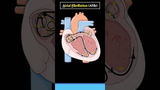 What is Atrial Fibrillation AF or AFib atrialfibrillation cardiology arrhythmia heart [upl. by Rodrique272]