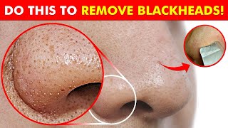 How to Remove Blackheads at Home  10 DIY Hacks for Perfect Skin Goodbye Blackheads [upl. by Nileuqcaj]