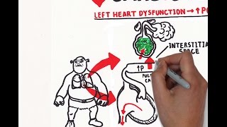 Pulmonary edema USMLE step 1 [upl. by Clea]